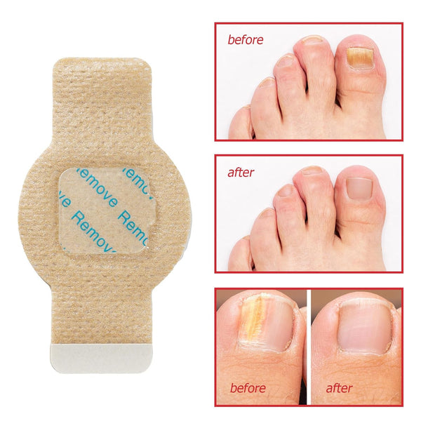 NailHeal™ - Fungal Nail Patches 🌿💅 ( Buy 10 Get 10 Free🔥🔥)